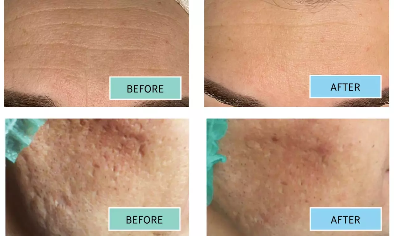 Up to 66% Off on Facial - Chemical Peel at UK Aesthetics Lounge