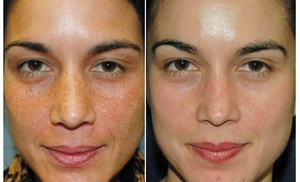 Experience Radiant Skin with VI Peel and Free Consultation