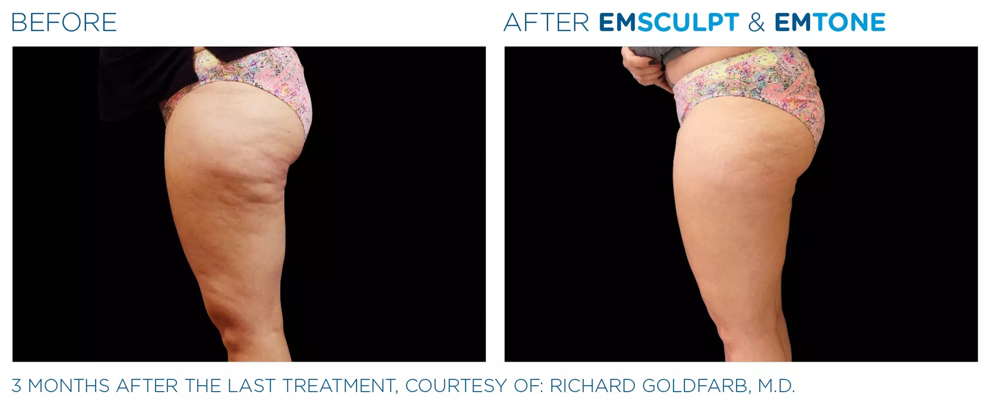 Up to 20% Off on Ultrasonic Fat Reduction at Jennifer R. Berman - Primary Image