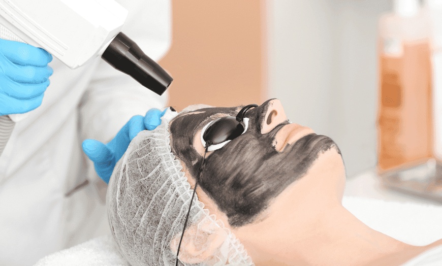 Image 1: Carbon Laser Peel Facial at Regains Beauty & Aesthetics