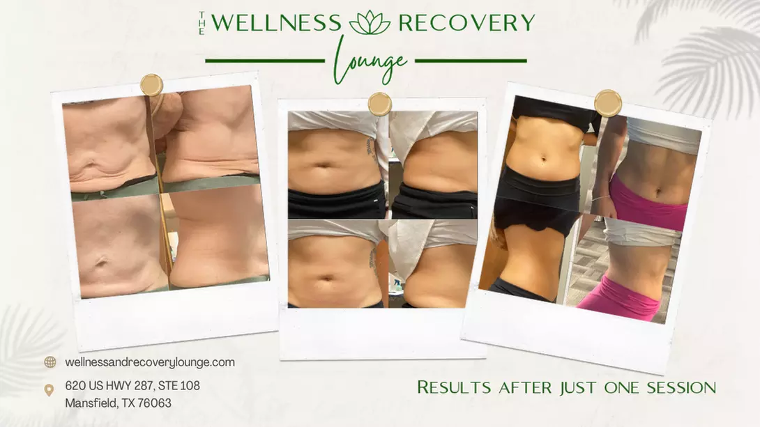 Unlock The Wellness and Recovery Lounge's Introductory Body Contouring