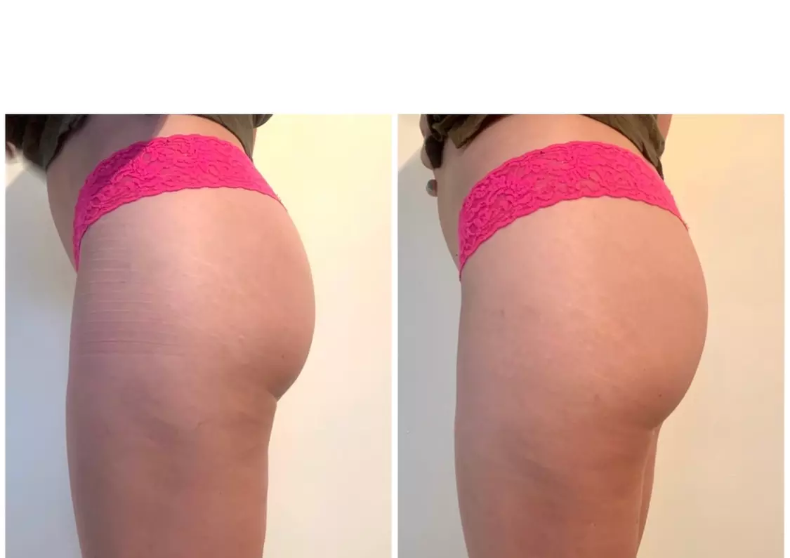 Experience a Brazilian Butt Lift with EMS Technology