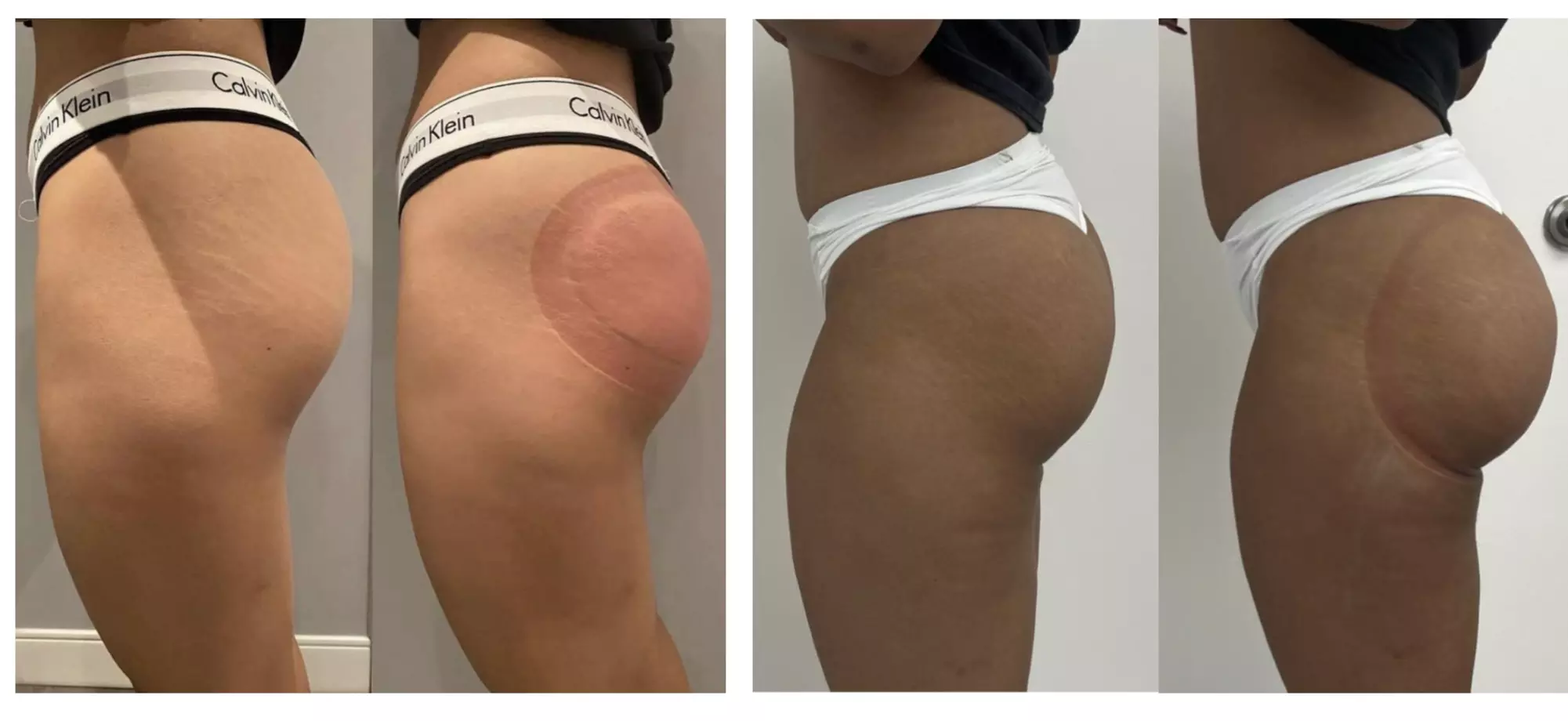 SlimmThicc Aesthetics Spa offers non-surgical butt enhancements with up to 65% off for a firmer and fuller look. - Primary Image
