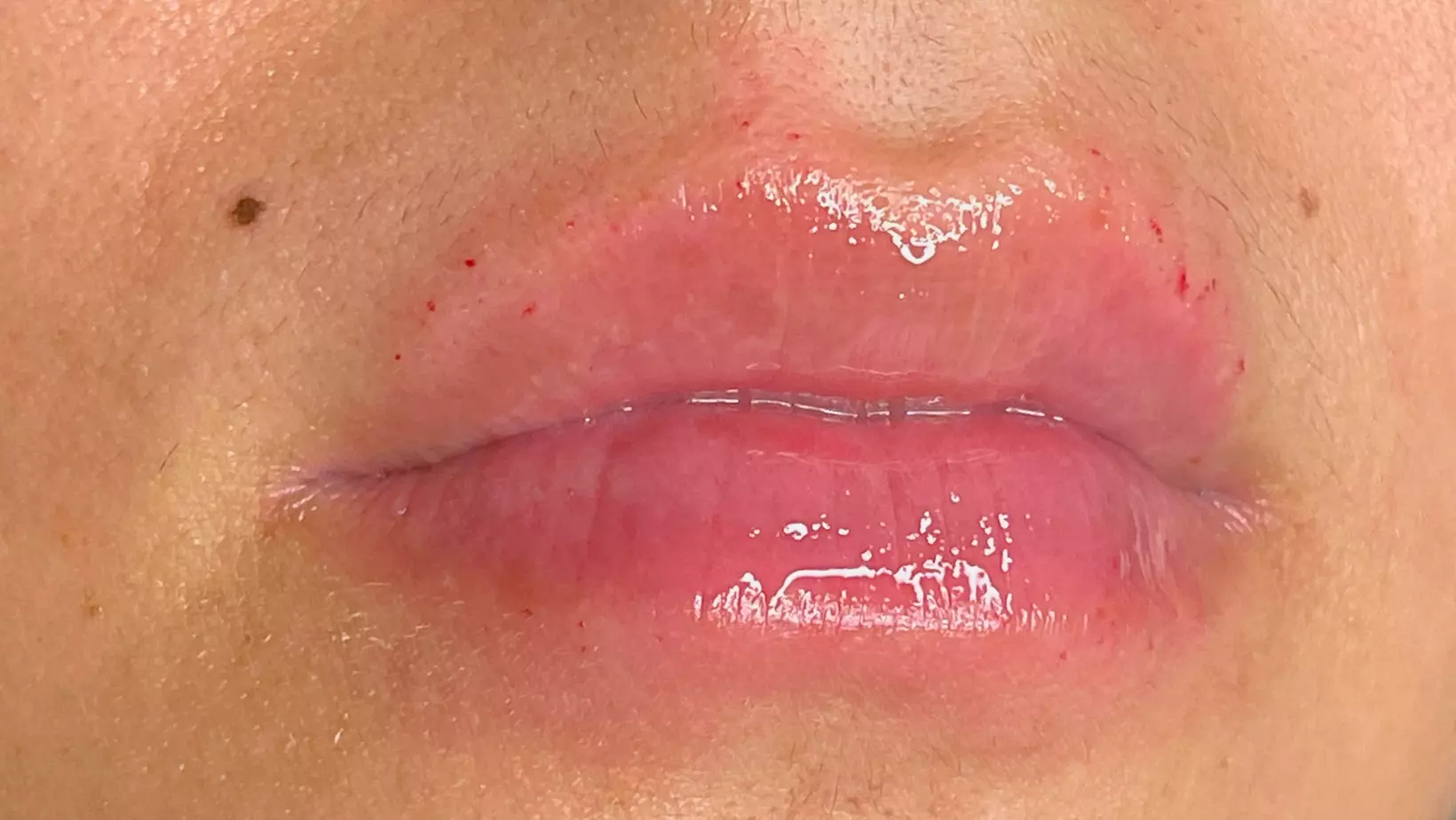 Up to 51% Off on Injection - Hyaluronic Acid at Adena’s Aesthetics - Second Medium