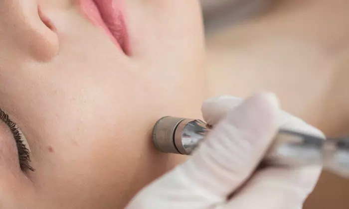 Relax with One 30-Minute Custom Facial with Microdermabrasion or Mechanical Exfoliation (Up to 47% Off) - Second Medium