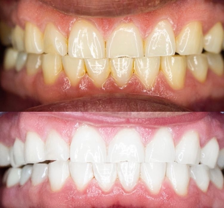 Teeth Whitening Treatment for Two: Brighten Your Smile