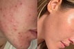 Up to 53% Off on Acne Treatment at Complexion Esthetician - Second Medium