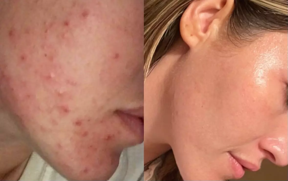 Up to 47% Off on Acne Treatment at Complexion Esthetician