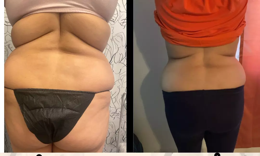 Transform Your Body with Ultrasonic Fat Reduction in Philly
