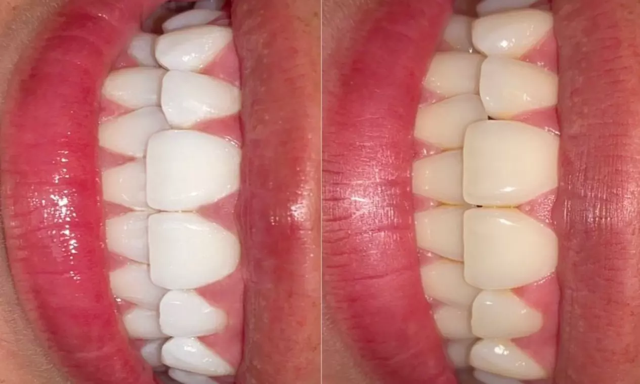 Up to 45% Off on Teeth Whitening at Sugar Esthetics By Nims - Primary Image