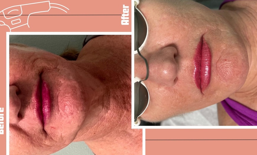 Image 2: Up to 59% Off on Laser Skin Resurfacing at Aesthetics Care Med Spa