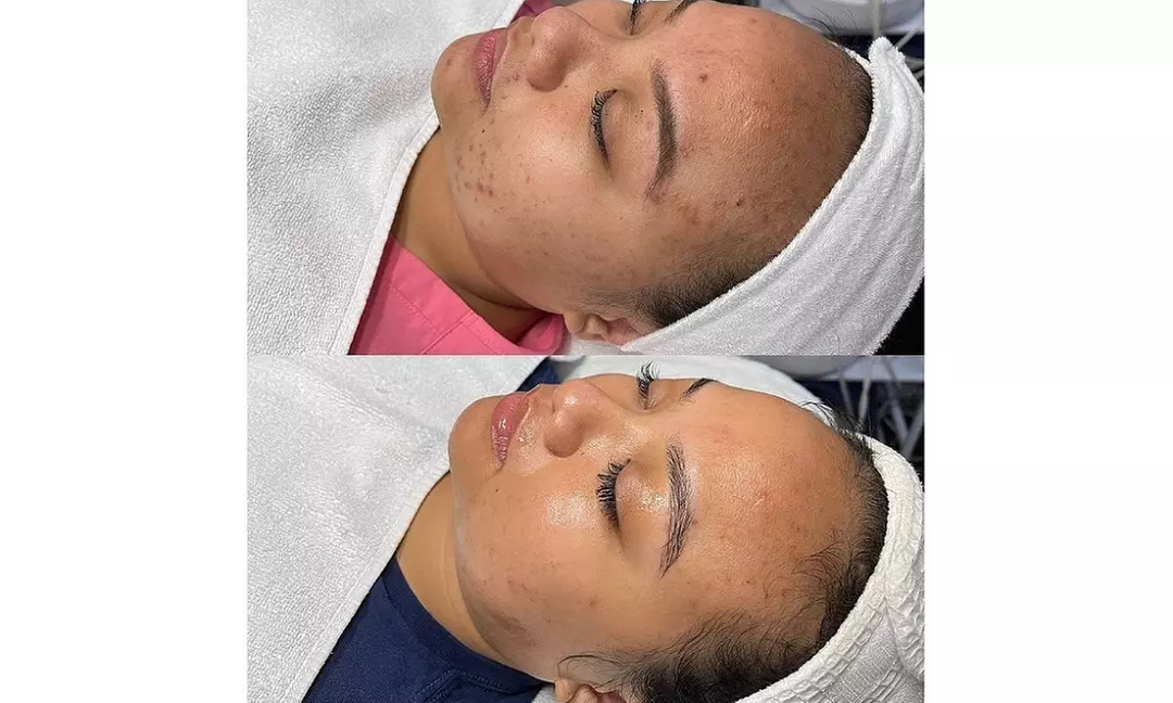 Up to 35% Off on Micro-Needling at Sexy Visage - Primary Image