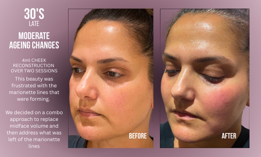 Image 4: Up to 38% Off on Injection - Dermal Filler at Divine Aesthetics Clinic London