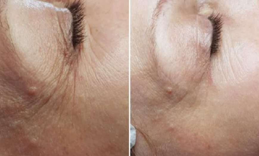 Image 2: Skin or Hair Rejuvenation with 3 Sessions of Polynucleotide Injections