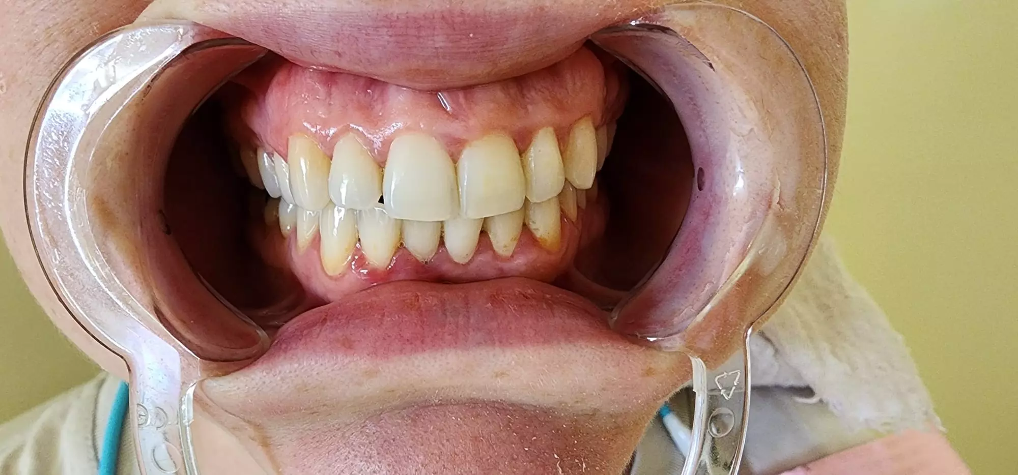 Brighten Your Smile with One Teeth Whitening Treatment