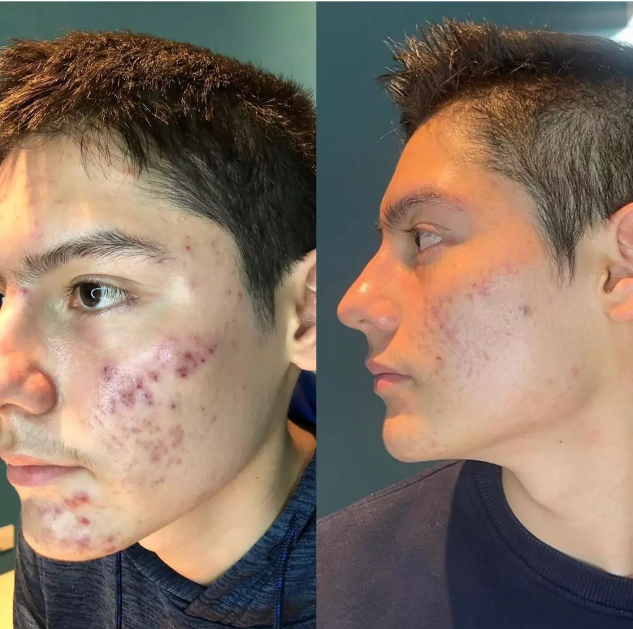Say Goodbye to Acne: Plason Plasma Clear Acne Treatment Plan