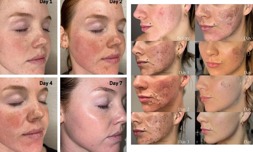 Image 3: Up to 73% Off on Facial - Chemical Peel at bc clinic