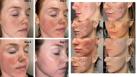 One Session Chemical Peel, Facial Cleansing - bc clinic