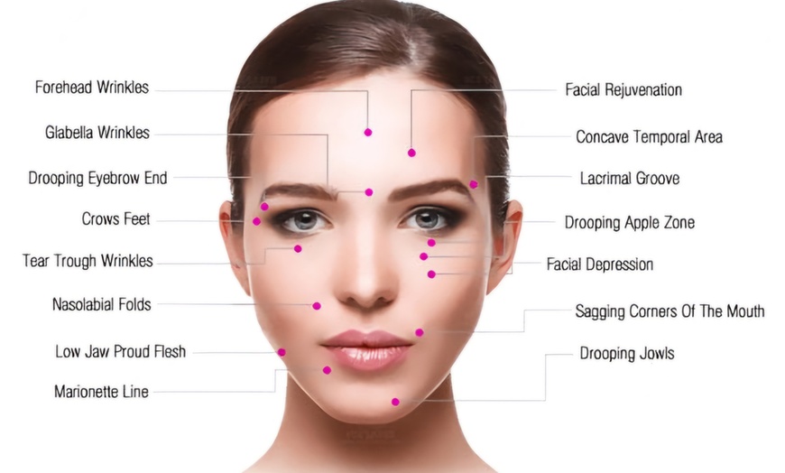 Image 7: Lift & Define: One Mid or Lower Face HIFU Face Lift