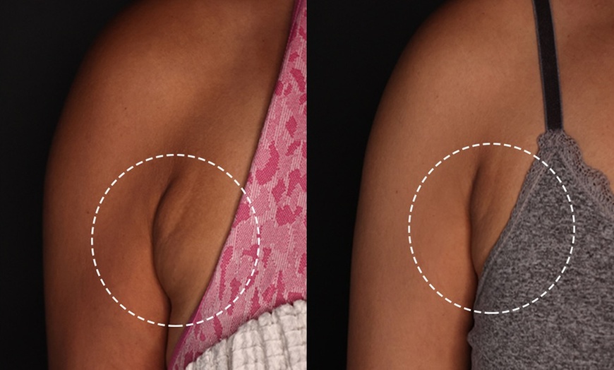 Image 4: Morpheus 8 Face and Neck / Abdomen or Butt Treatment at No Pain All Gain Spa (Up to 37% Off)