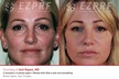 Up to 47% Off on Injection - Plasma at Total Body Aesthetics - Second Medium