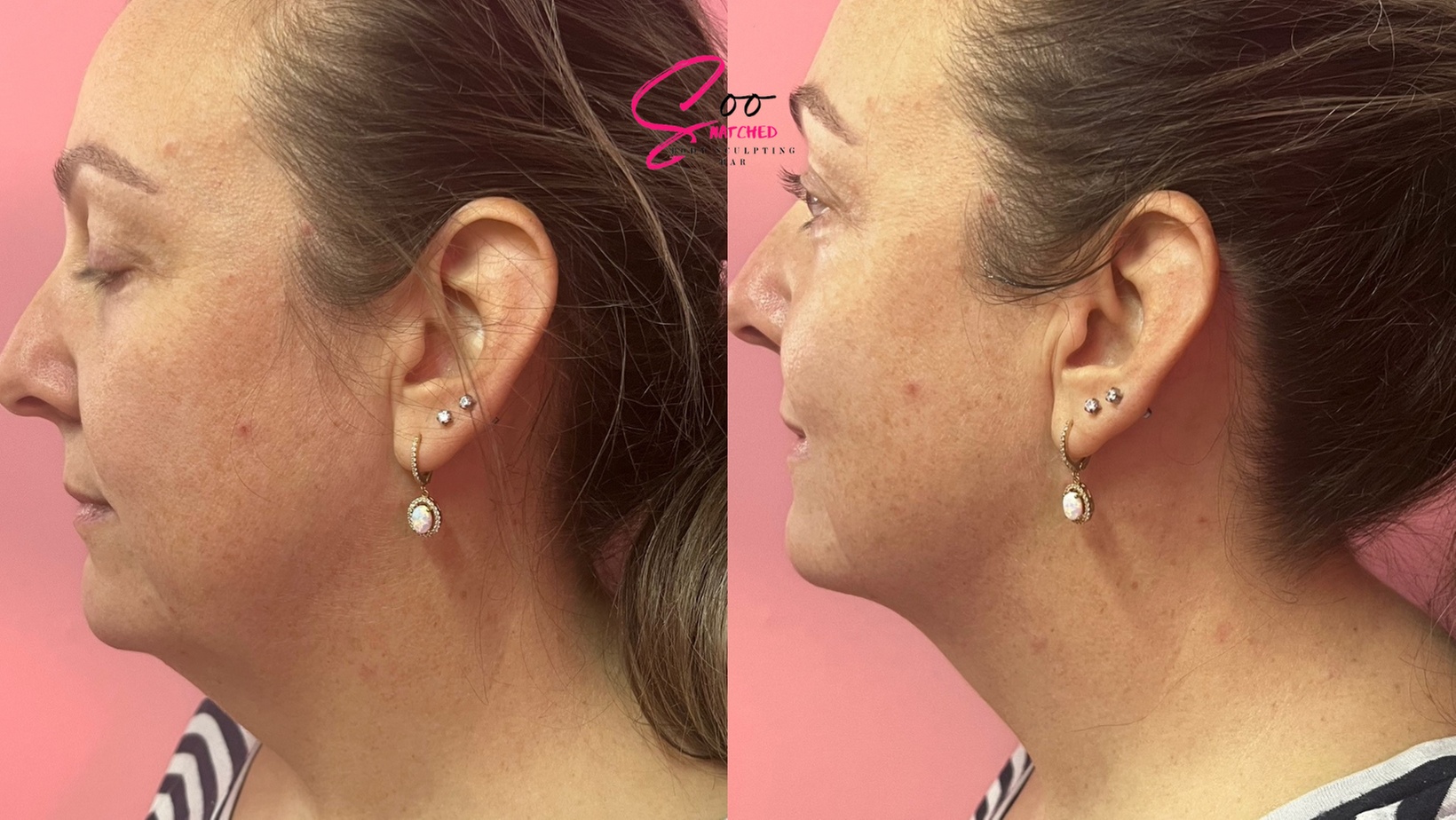 Radio frequency skin tightening treatments for body sculpting