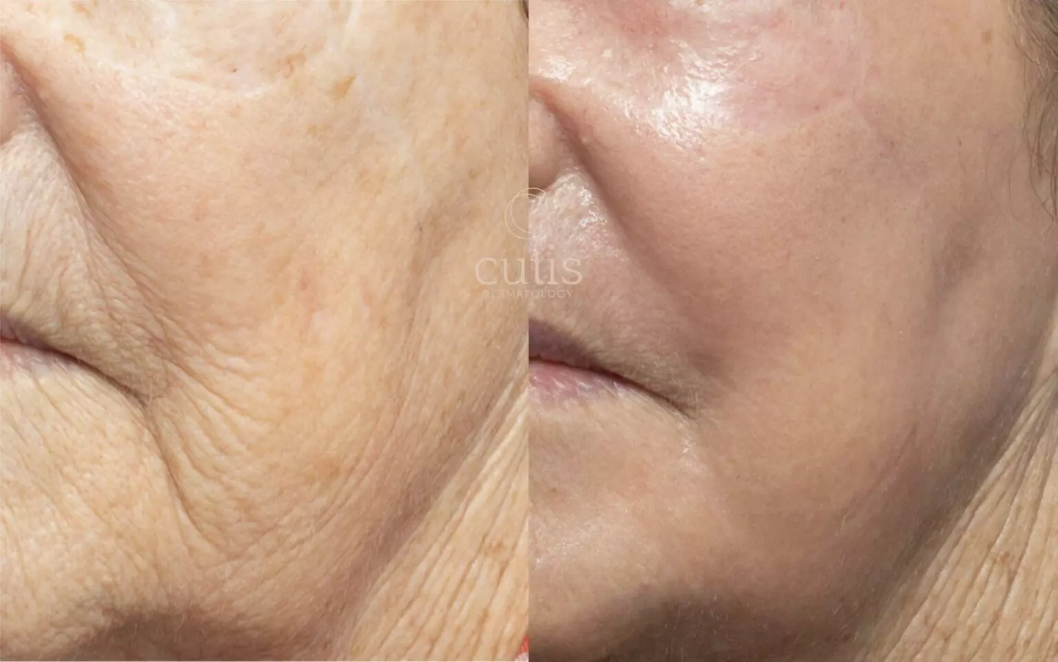 Up to 78% Off on IPL/Photofacials at SlimmThicc Aesthetics Spa