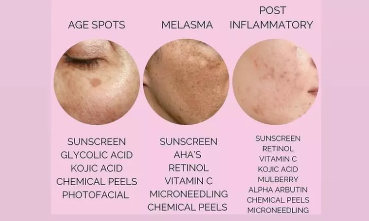 Microdermabrasion Facial or Acne Treatment Facial with High Frequency