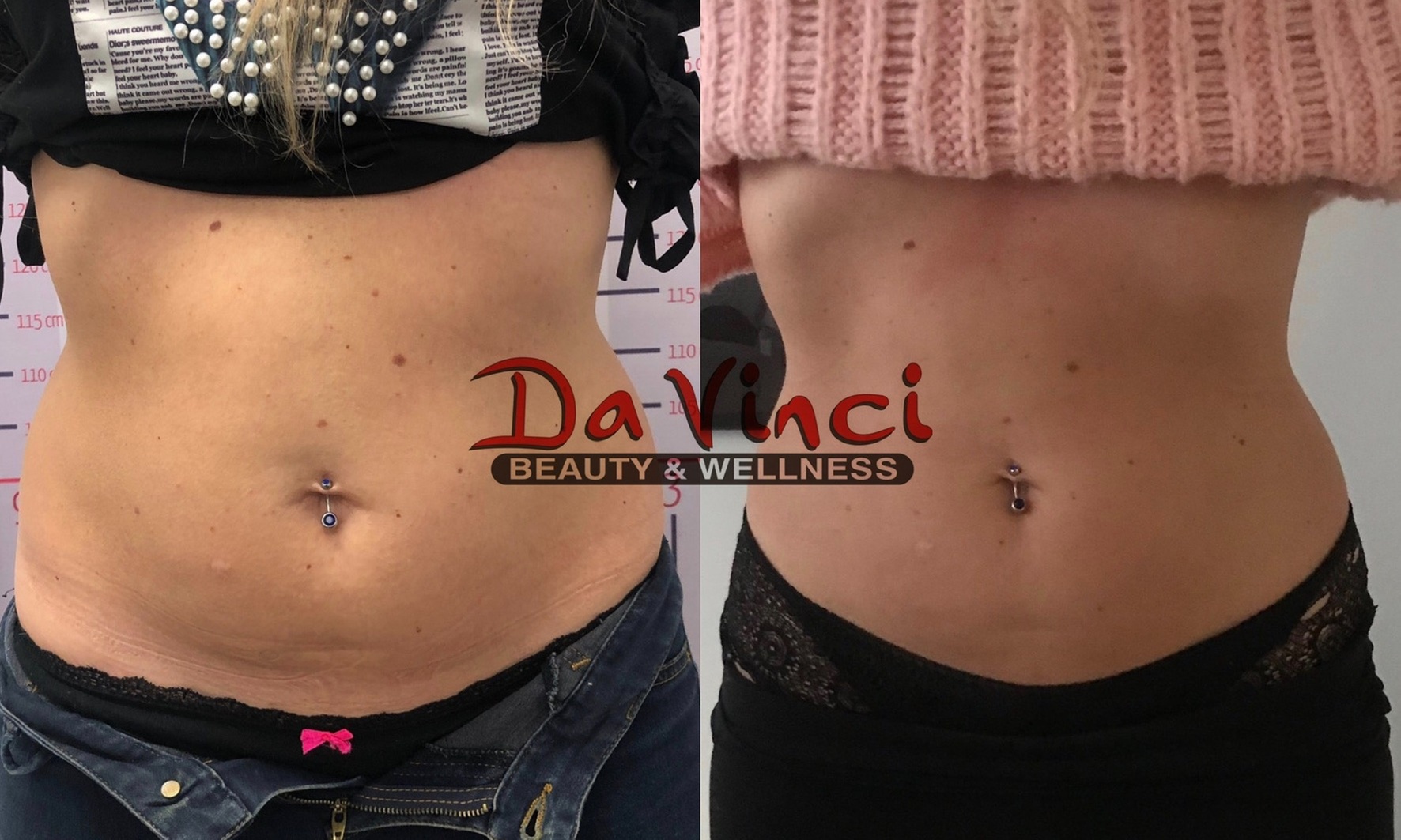 Experience Ultrasonic Cavitation with Two to Six Sessions