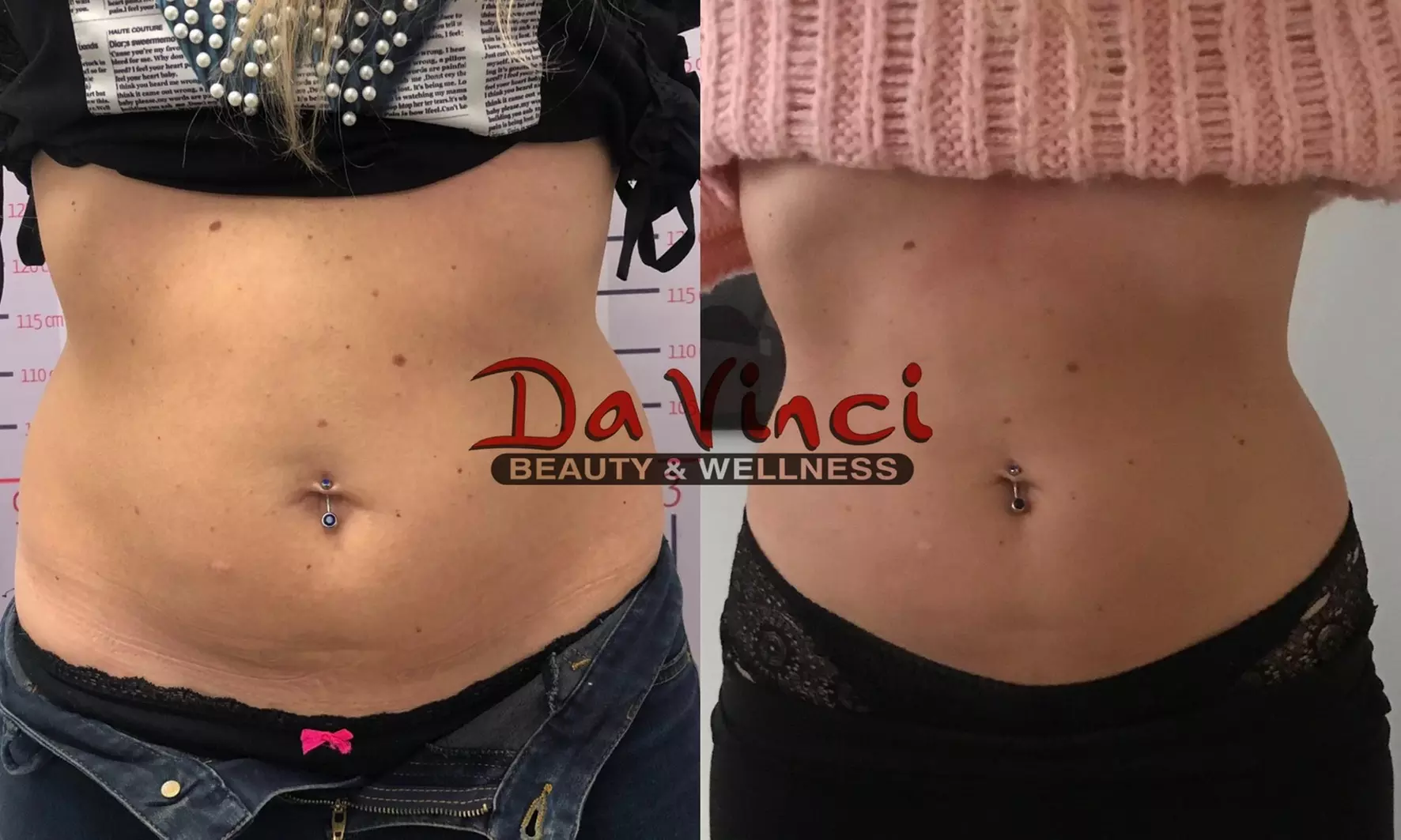 Explore DaVinci Beauty & Wellness Center's ultrasonic cavitation options,offering upto 60% off for a tailored experience - Primary Image