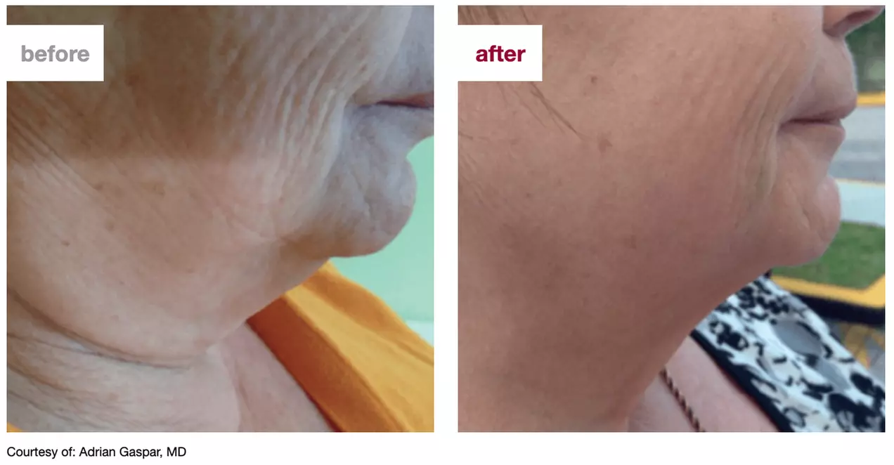 Up to 50% Off on Laser Skin Resurfacing at Oregon Derma Center - Primary Image