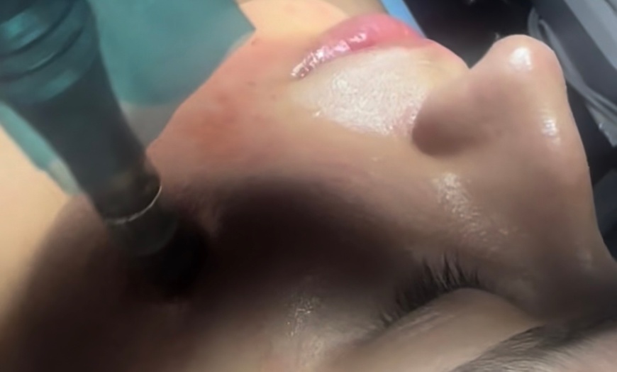 Image 2: Rejuvenate with Microneedles Exosomes Face and Neck
