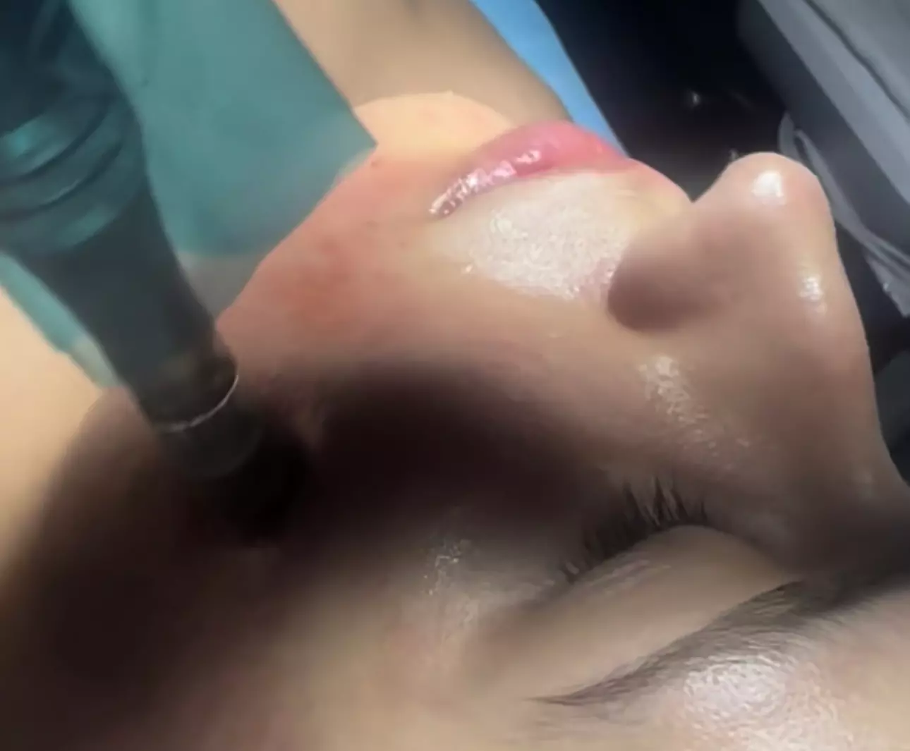 Rejuvenate with Microneedles Exosomes Face and Neck