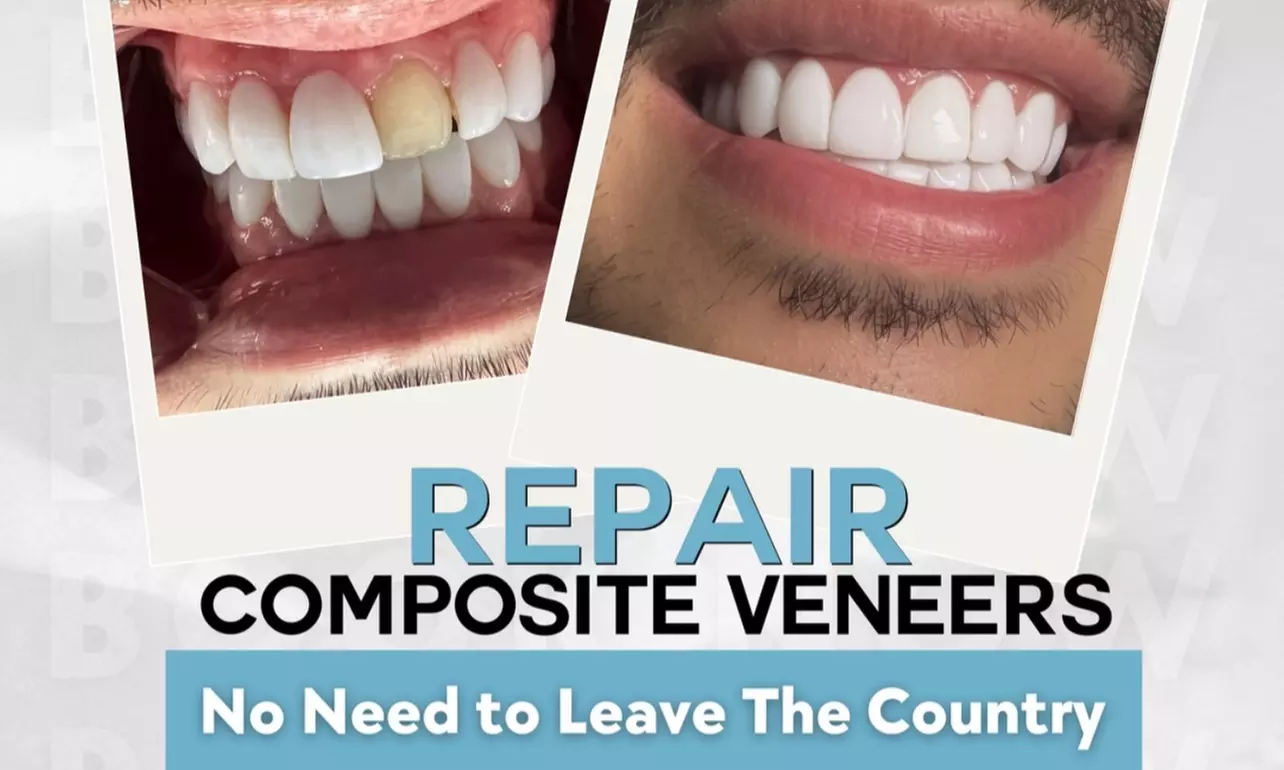 Up to 59% Off on Dental Implant / Corona / Veneer at The Glowing Smile - Primary Image