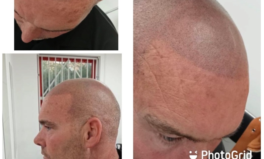 Image 2: Up to 50% Off on Salon - Scalp Care at FreMat SMP Clinic (Scalp Micropigmentation Clinic