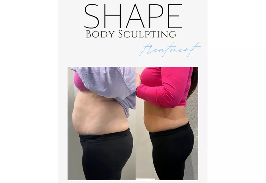 Experience Shape's Fat Freezing Cryo Body Sculpting Packages with savings up to 76% for a transformative body experience - Primary Image