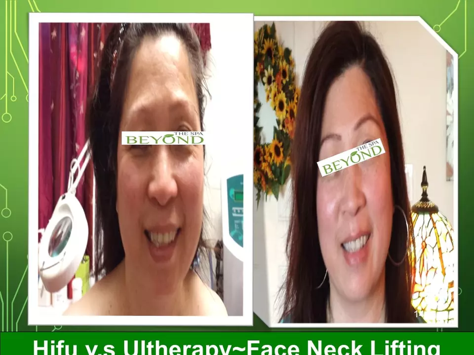 Lymphatic Drainage Massage with Hifu Options for Face and Body