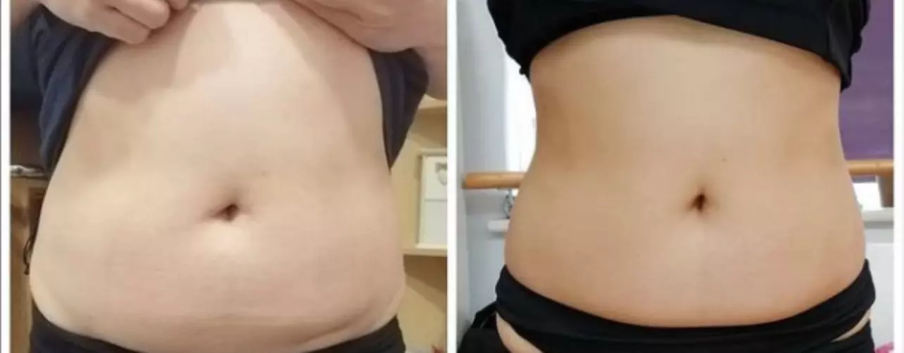 Achieve a new sculpted look at Peculiar Wellness Center with up to 65% off on 1, 3, or 6 EMS Body Sculpt Sessions - Primary Image