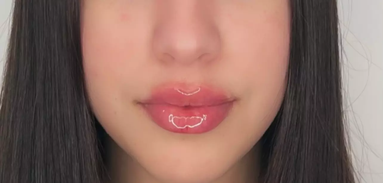 Plump & Hydrate Lips with Restylane Kysse Lip Filler Treatment
