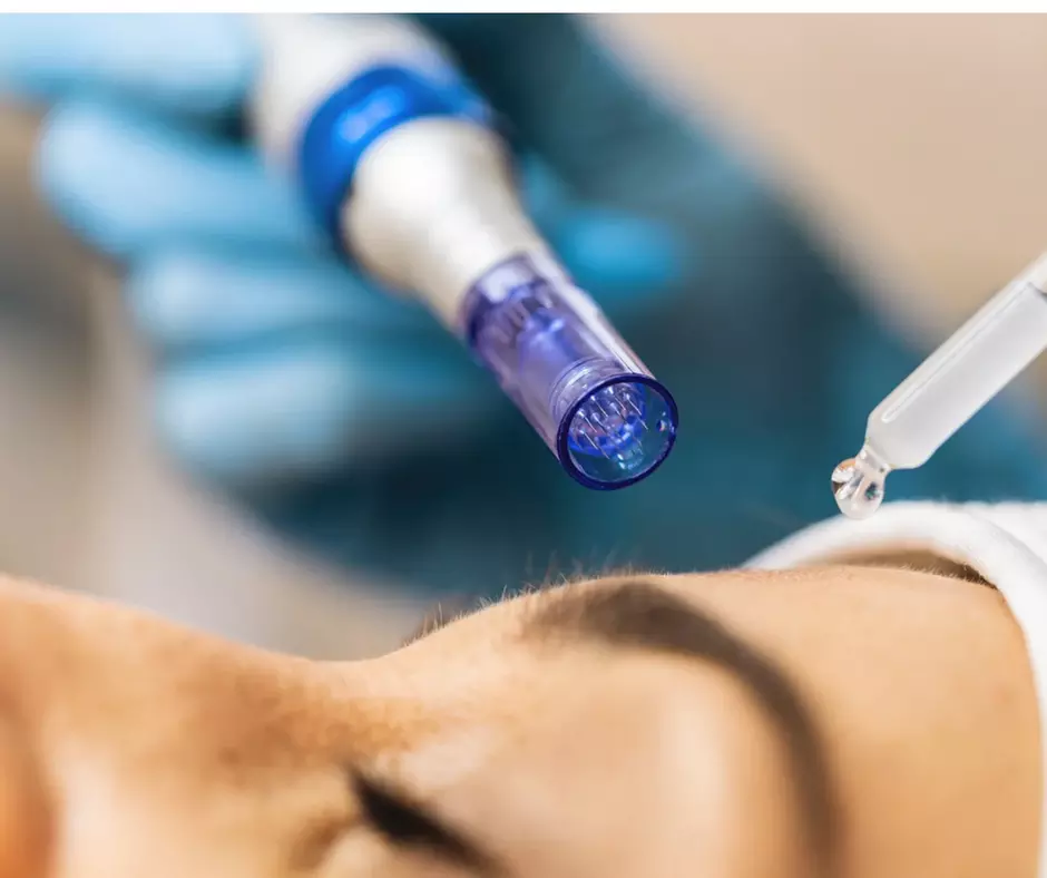 Up to 74% Off on Micro-Needling at Lasser4u - Primary Image