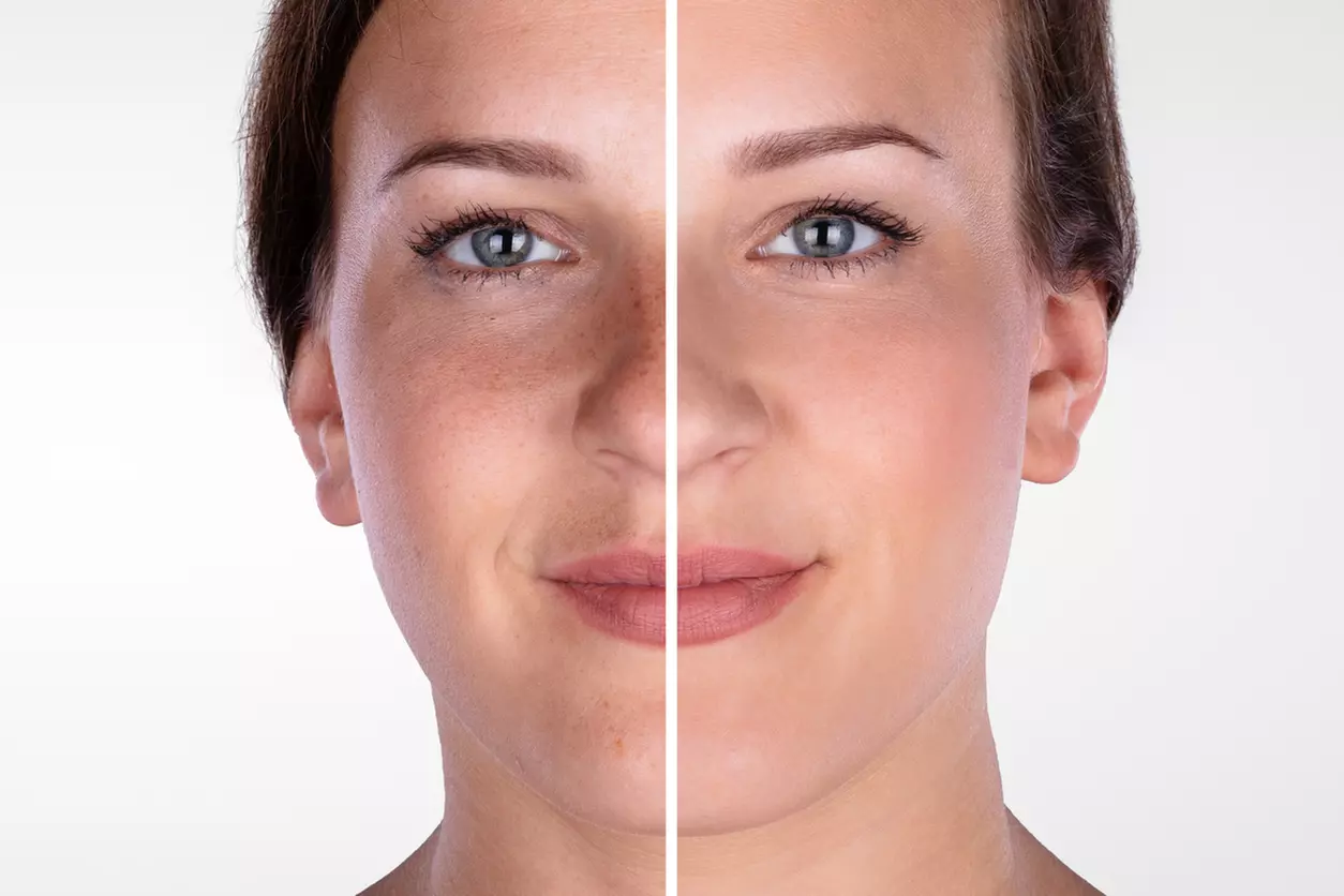 Up to 45% Off on Microdermabrasion at The Sculpting Art - Second Medium
