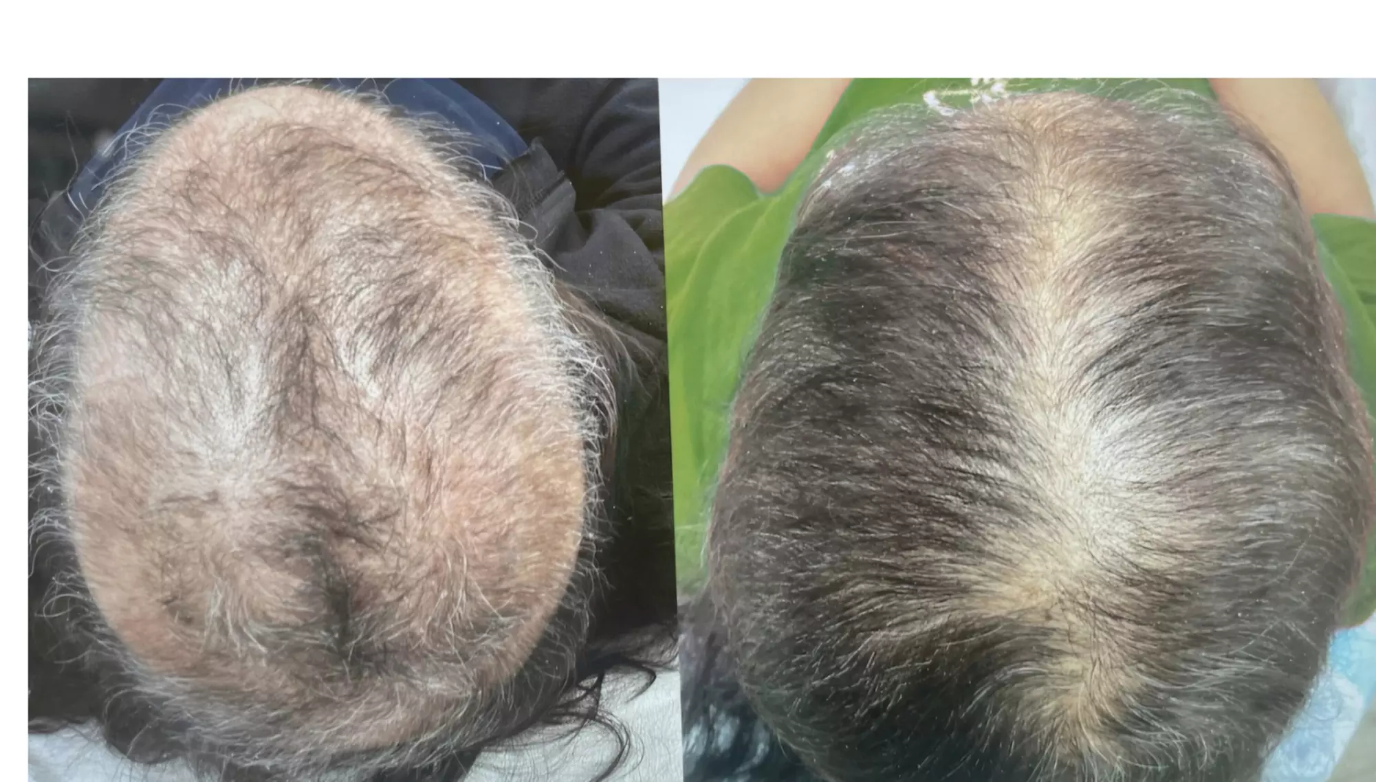 Up to 50% Off on Hair Restoration - Non-Surgical at Restorative Med Spa NYC - Primary Image