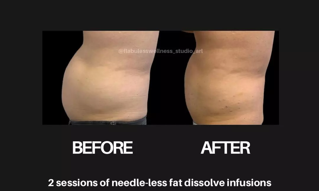Up to 51% Off on Needle-Free Fat Dissolve Infusion