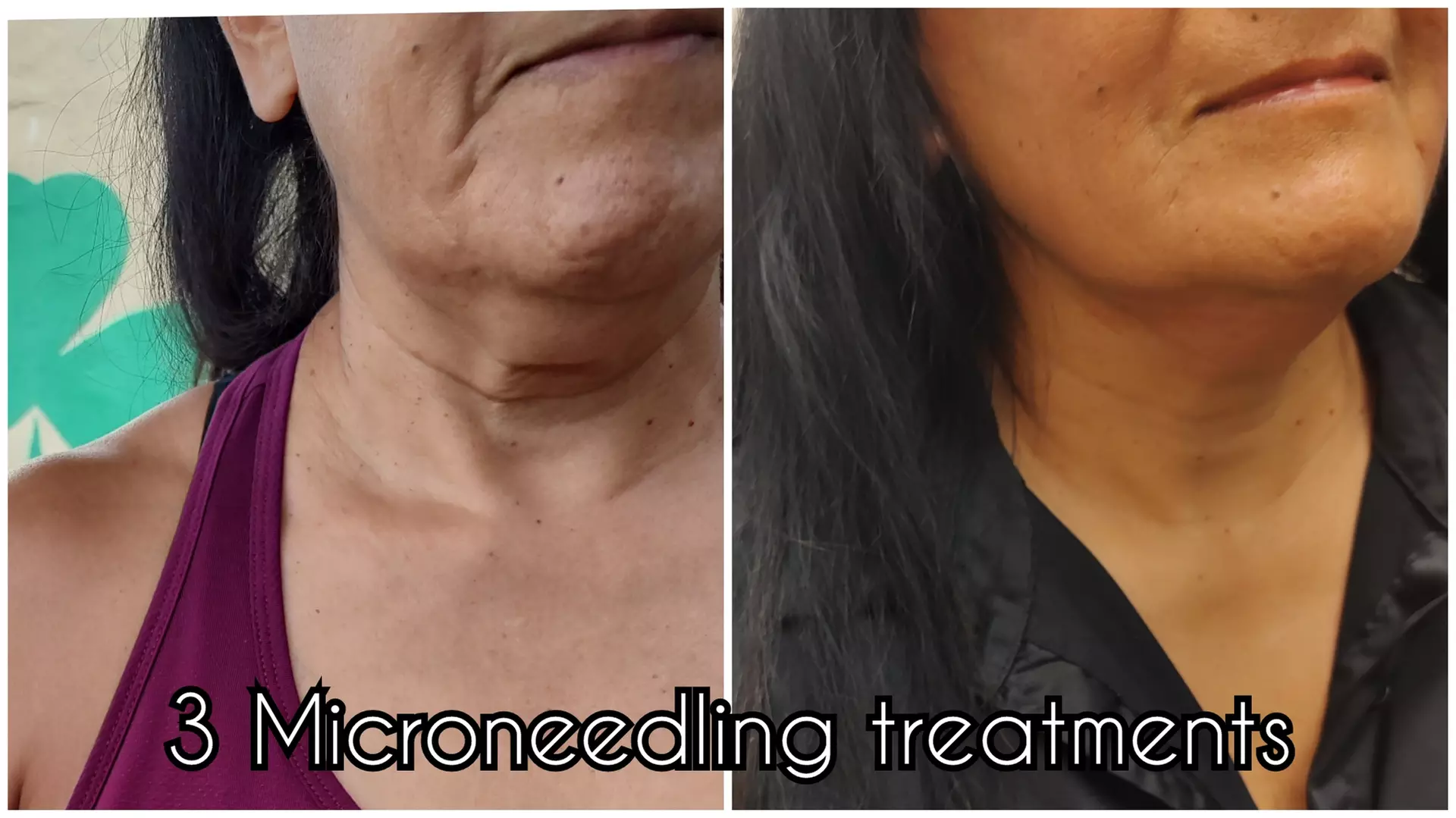 Up to 60% Off on Micro-Needling at The Shape Shack - Primary Image