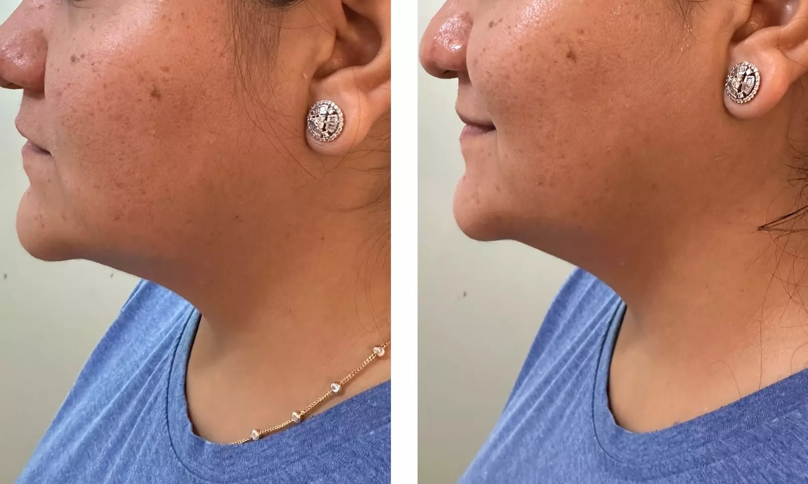 Up to 65% Off on Facelift - Non-Surgical at Velvet Vanity By Puja