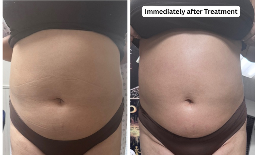 Image 2: Achieve Body Contouring With 4 or 8 Paddle Cryolipolysis