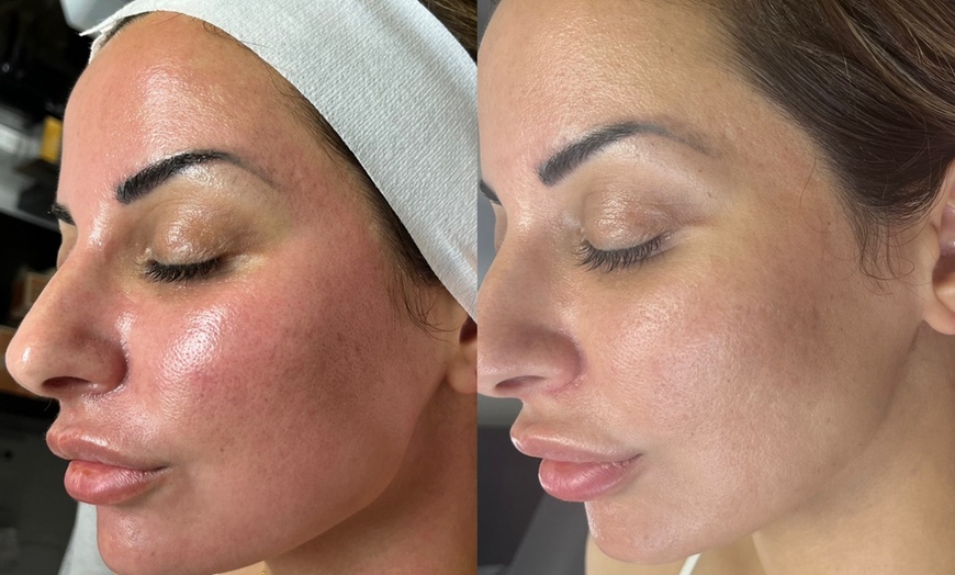 Image 4: Transform Your Look With One or Two Micro-Needling Treatments