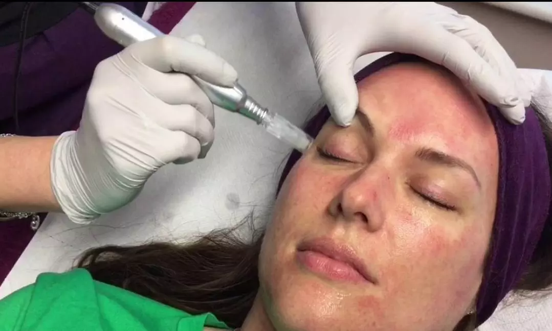Up to 30% Off on Micro-Needling at Dermapure, LLC