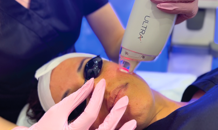 Revitalize Your Glow: UltraGlo Fractional Skin Resurfacing Treatment
