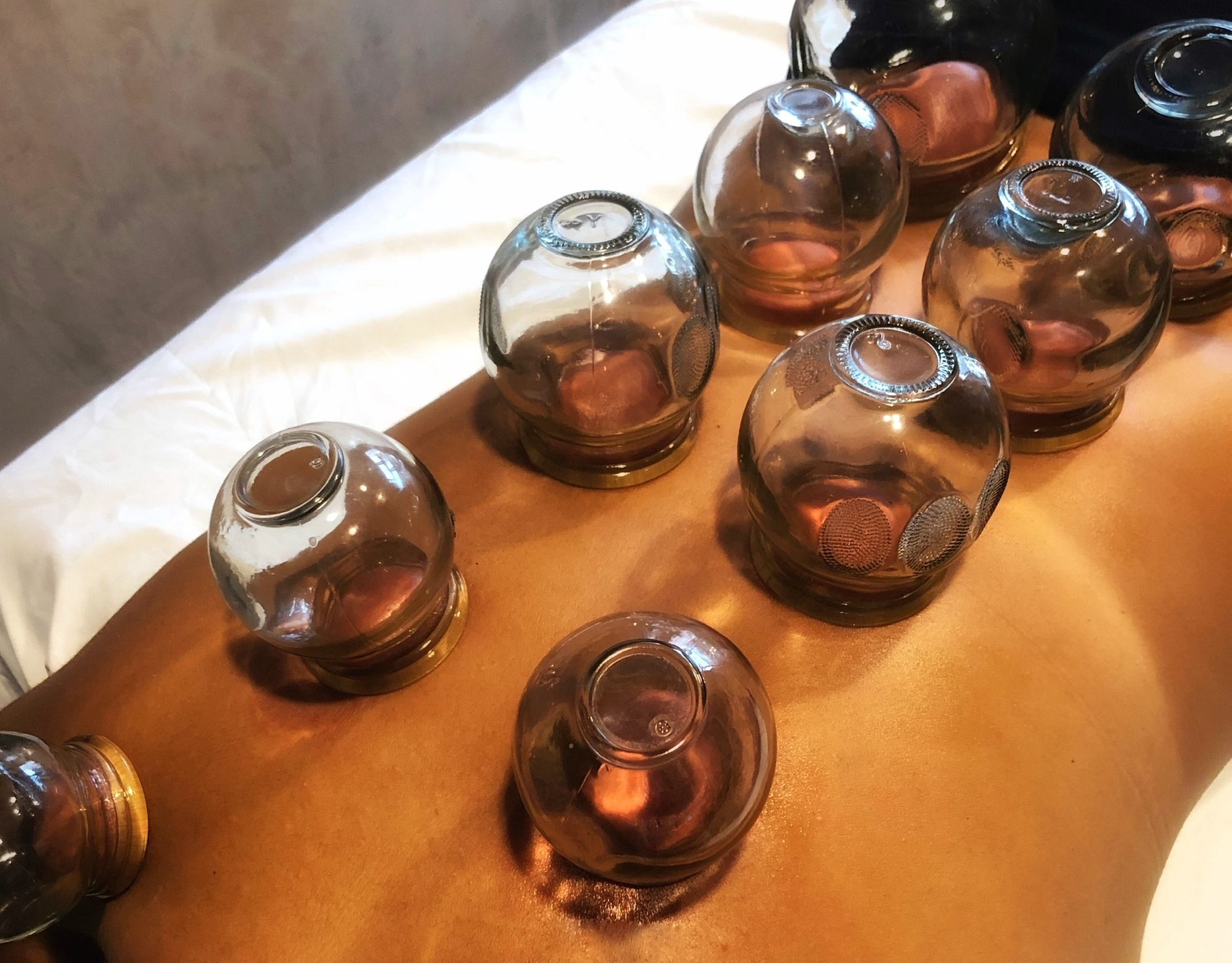 Experience relief with a single cupping session for sore muscles